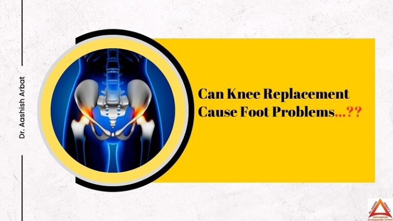 can-knee-replacement-cause-foot-problems-best-joint-replacement