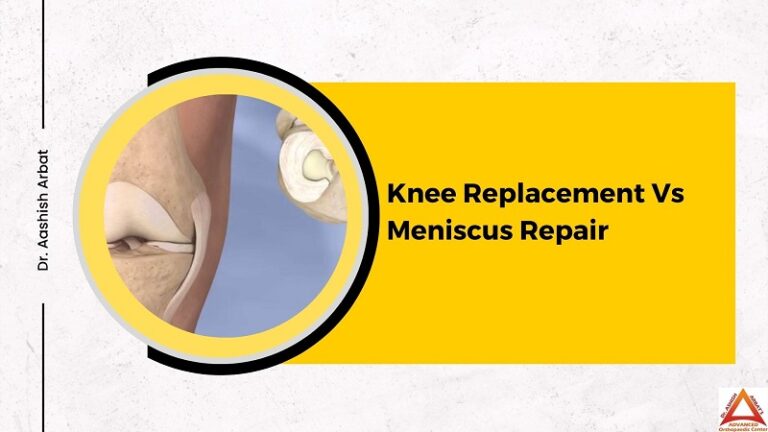 Knee Replacement Vs Meniscus Repair