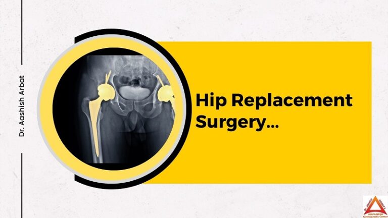 Hip Replacement Surgery [Hip Replacement Surgery Time]