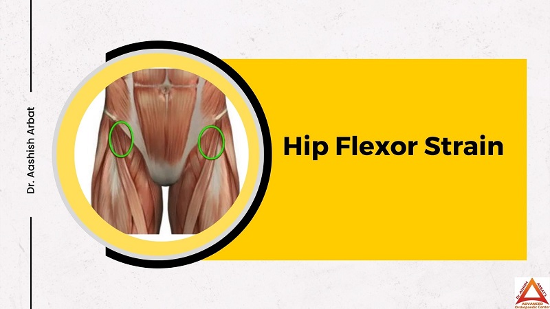 Hip Flexor Strain