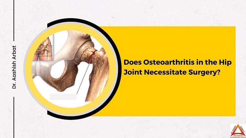 Does Osteoarthritis in the Hip Joint Necessitate Surgery