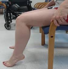 pictures of swollen leg after hip replacement - 1
