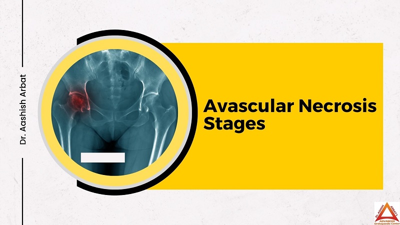 Avascular Necrosis Stages