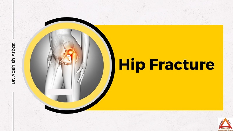 Hip Fracture