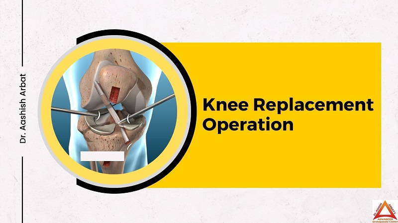 Knee Replacement Operation