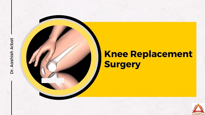 Knee Replacement Surgery