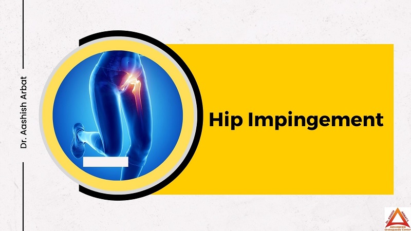 Hip Impingement