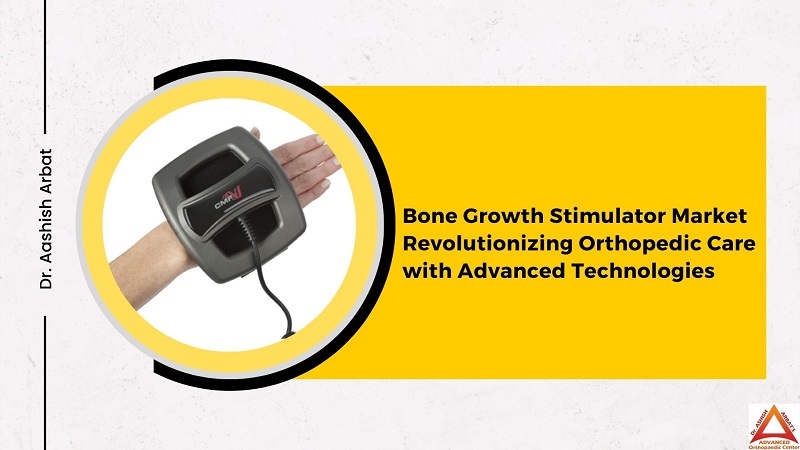 Bone Growth Stimulator Market Revolutionizing Orthopedic Care with Advanced Technologies